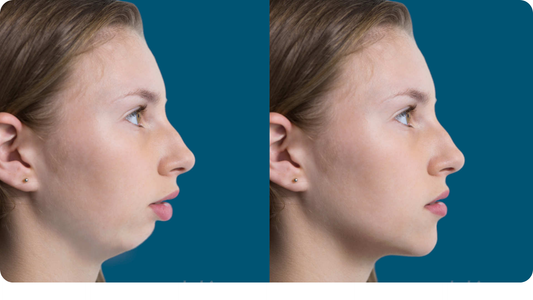 The "Sleep" Guide: How Nasal Breathing Sculpts Your Jawline